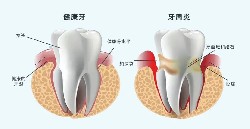 牙齿的沉默杀手——牙周炎！