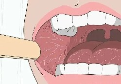 口腔里的白色纹路：带你认识口腔扁平苔藓！
