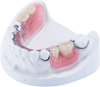 局部活动假牙（下颌）